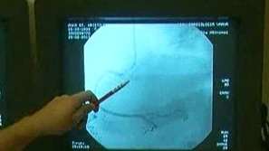 По-малко пари за кардиоболниците