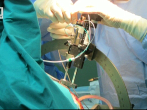 първа мозъчна операция болен паркинсон нас